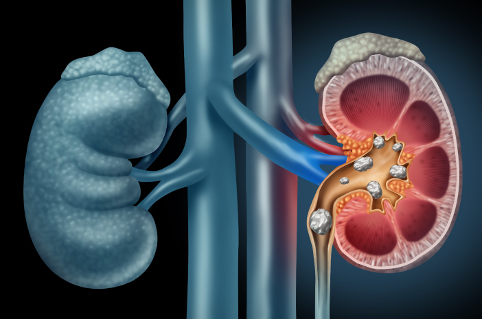 Apa itu Glomerulonefritis